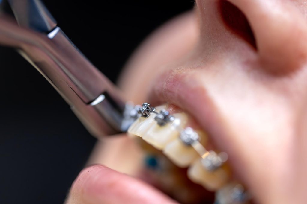 Braces Price in Malaysia: A Comprehensive Breakdown for Every Budget
