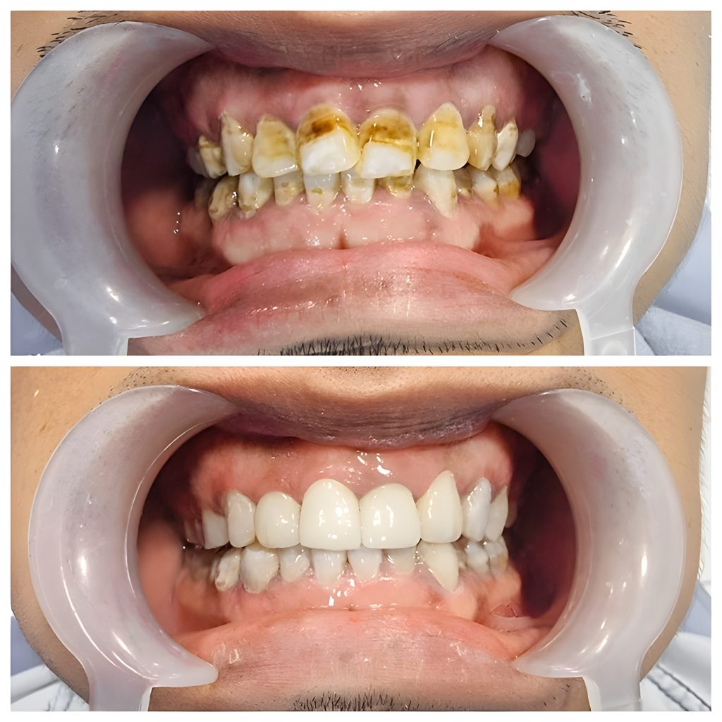 Before-and-after comparison showing dental veneer treatment results, restoring stained, misaligned teeth to a clean, white, and evenly shaped smile.