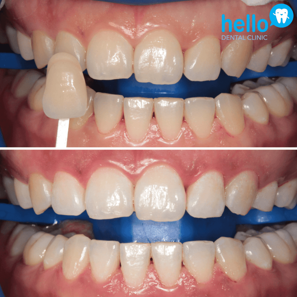 tooth whitening improving stained teeth